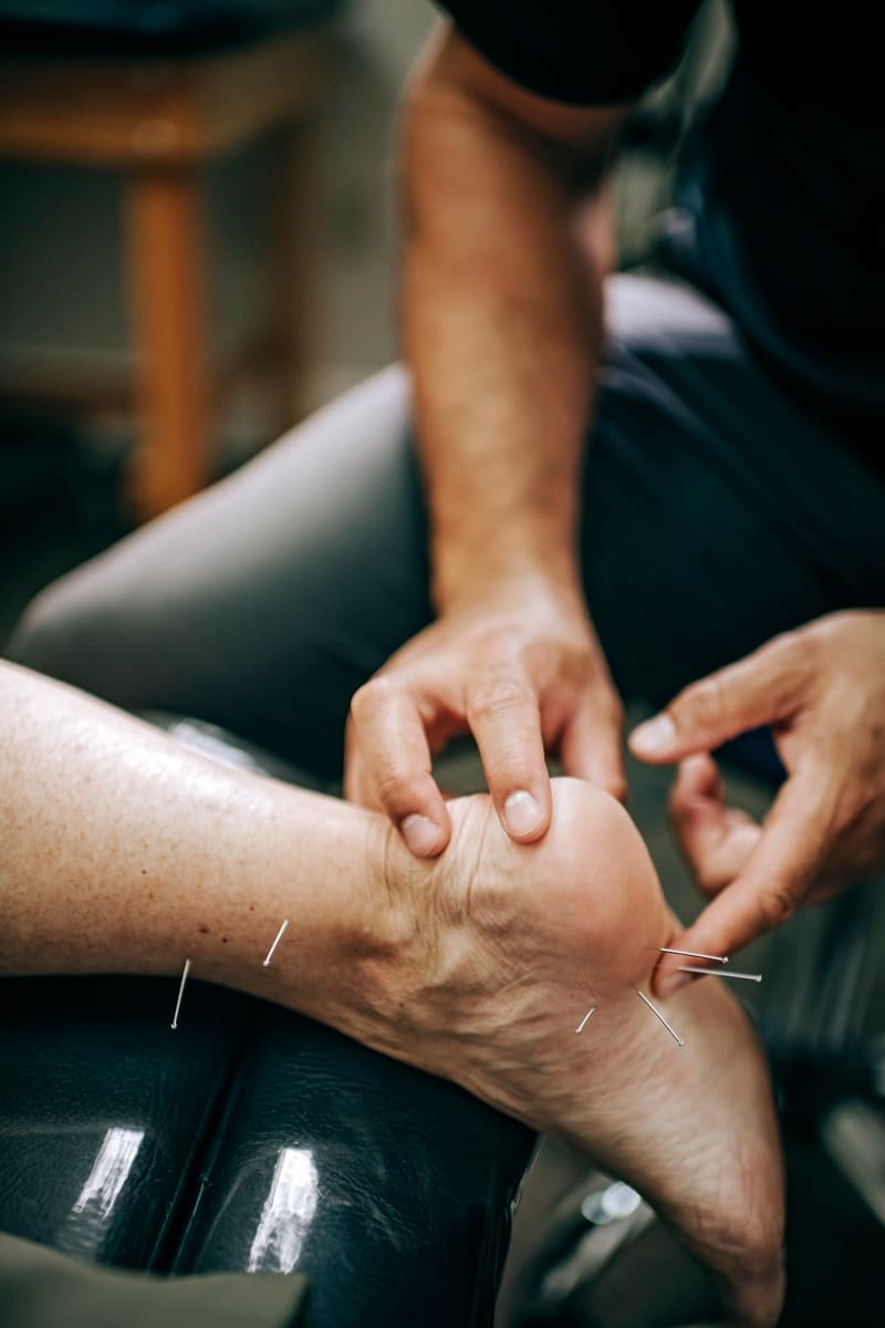 Dry Needling